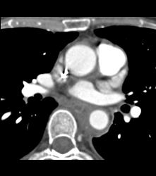 Intramural Hematoma - CTisus CT Scan