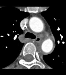 Intramural Hematoma - CTisus CT Scan