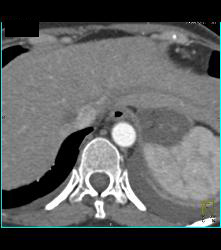 Intramural Hematoma - CTisus CT Scan