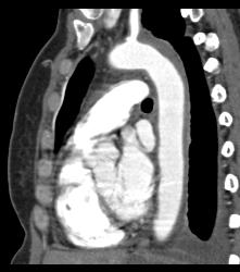 Intramural Hematoma - Vascular Case Studies - CTisus CT Scanning