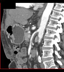 Atherosclerotic Changes in SMA - CTisus CT Scan