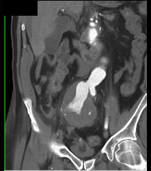 Iliac Artery Aneurysm With Leak - CTisus CT Scan