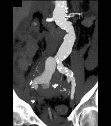 Iliac Artery Aneurysm With Leak - CTisus CT Scan