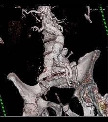 Iliac Artery Aneurysm With Leak - CTisus CT Scan