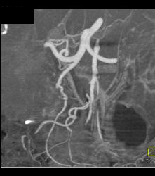 Diseased Superior Mesenteric Artery (SMA) and Celiac Artery - CTisus CT Scan