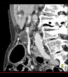 Diseased Superior Mesenteric Artery (SMA) and Celiac Artery - CTisus CT Scan