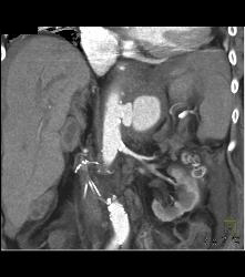 Mycotic Aneurysm - CTisus CT Scan