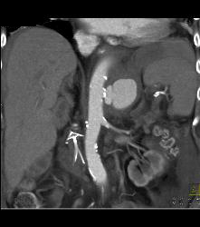 Mycotic Aneurysm - CTisus CT Scan