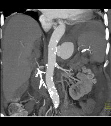 Mycotic Aneurysm - CTisus CT Scan