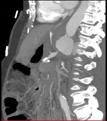 Mycotic Aneurysm - CTisus CT Scan