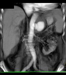 Mycotic Aneurysm - CTisus CT Scan