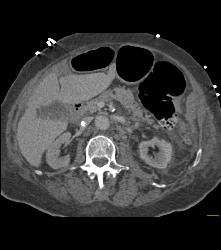 Mycotic Aneurysm - CTisus CT Scan