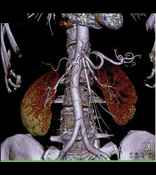 Mesenteric Arcade With VRT - CTisus CT Scan