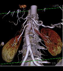 Mesenteric Arcade With VRT - CTisus CT Scan