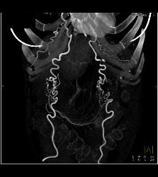 Collaterals in Abdominal Wall - CTisus CT Scan