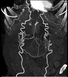 Collaterals in Abdominal Wall - CTisus CT Scan