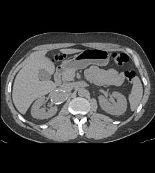 Large Right Renal Artery Aneurysm - CTisus CT Scan