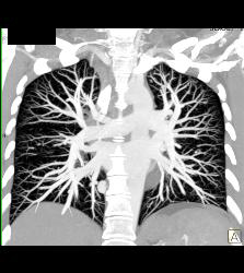 Pulmonary Arteriovenous Malformation (PAVM) in Patient With Hereditary Hemorrhagic Telangiectasia (HHT) Syndrome - CTisus CT Scan