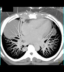 Pulmonary Arteriovenous Malformation (PAVM) in Patient With Hereditary Hemorrhagic Telangiectasia (HHT) Syndrome - CTisus CT Scan