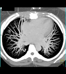 Pulmonary Arteriovenous Malformation (PAVM) in Patient With Hereditary Hemorrhagic Telangiectasia (HHT) Syndrome - CTisus CT Scan