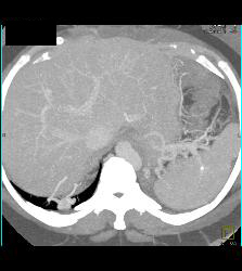 Pulmonary Arteriovenous Malformation (PAVM) in Patient With Hereditary Hemorrhagic Telangiectasia (HHT) Syndrome - CTisus CT Scan