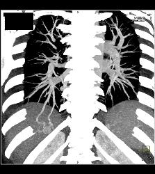 Pulmonary Arteriovenous Malformation (PAVM) in Patient With Hereditary Hemorrhagic Telangiectasia (HHT) Syndrome - CTisus CT Scan