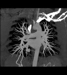 Pulmonary Arteriovenous Malformation (PAVM) in Patient With Hereditary Hemorrhagic Telangiectasia (HHT) Syndrome - CTisus CT Scan