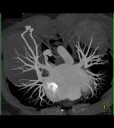 Pulmonary Arteriovenous Malformation (PAVM) in Patient With Hereditary Hemorrhagic Telangiectasia (HHT) Syndrome - CTisus CT Scan