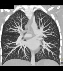 Pulmonary Arteriovenous Malformation (PAVM) in Patient With Hereditary Hemorrhagic Telangiectasia (HHT) Syndrome - CTisus CT Scan