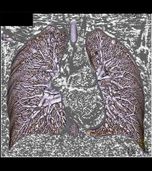 Pulmonary Arteriovenous Malformation (PAVM) in Patient With Hereditary Hemorrhagic Telangiectasia (HHT) Syndrome - CTisus CT Scan