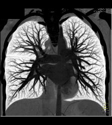 Pulmonary Arteriovenous Malformation (PAVM) in Patient With Hereditary Hemorrhagic Telangiectasia (HHT) Syndrome - CTisus CT Scan