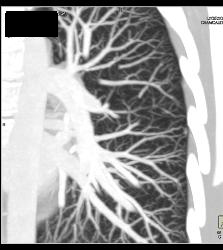 Pulmonary Arteriovenous Malformation (PAVM) in Patient With Hereditary Hemorrhagic Telangiectasia (HHT) Syndrome - CTisus CT Scan