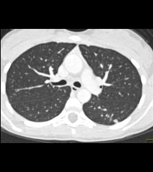 Pulmonary Arteriovenous Malformation (PAVM) in Patient With Hereditary Hemorrhagic Telangiectasia (HHT) Syndrome - CTisus CT Scan