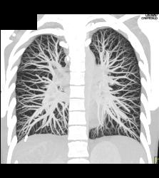 Pulmonary Arteriovenous Malformation (PAVM) in Patient With Hereditary Hemorrhagic Telangiectasia (HHT) Syndrome - CTisus CT Scan