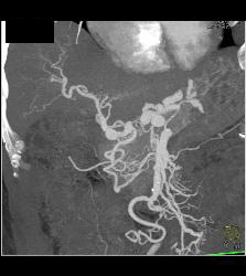 Hepatic Artery Aneurysms in Vasculitis - CTisus CT Scan