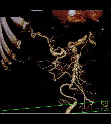 Hepatic Artery Aneurysms in Vasculitis - CTisus CT Scan