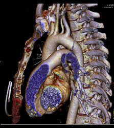 3D of Aortic Arch Vessels - CTisus CT Scan