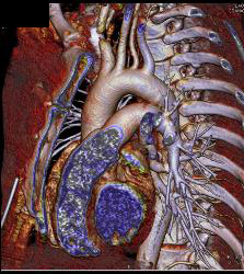 3D of Aortic Arch Vessels - CTisus CT Scan