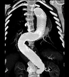 Endovascular Stent - CTisus CT Scan