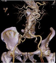 Endovascular Stent - CTisus CT Scan