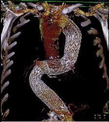 Endovascular Stent - CTisus CT Scan