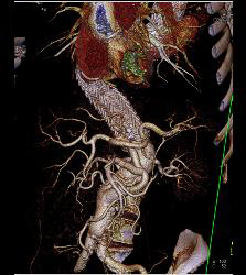 Endovascular Stent - CTisus CT Scan