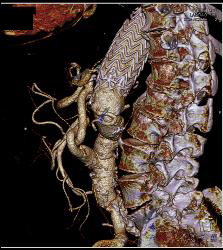 Endovascular Stent - CTisus CT Scan