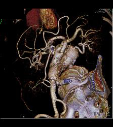 Endovascular Stent - CTisus CT Scan