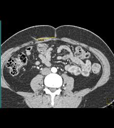 3D of Iliac Arteries - CTisus CT Scan