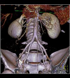 3D of Iliac Arteries - CTisus CT Scan