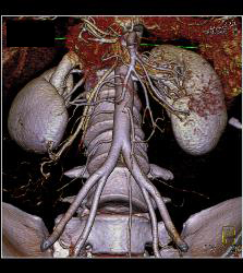 3D of Iliac Arteries - CTisus CT Scan