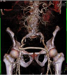 Occluded Left Iliac Artery With A Fem-fem Bypass - CTisus CT Scan