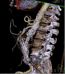 Occluded Left Iliac Artery With A Fem-fem Bypass - CTisus CT Scan