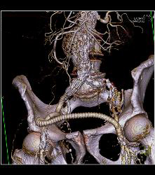 Occluded Left Iliac Artery With A Fem-fem Bypass - CTisus CT Scan